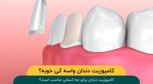 کامپوزیت-دندان-برای-چه-کسانی-مناسب-است